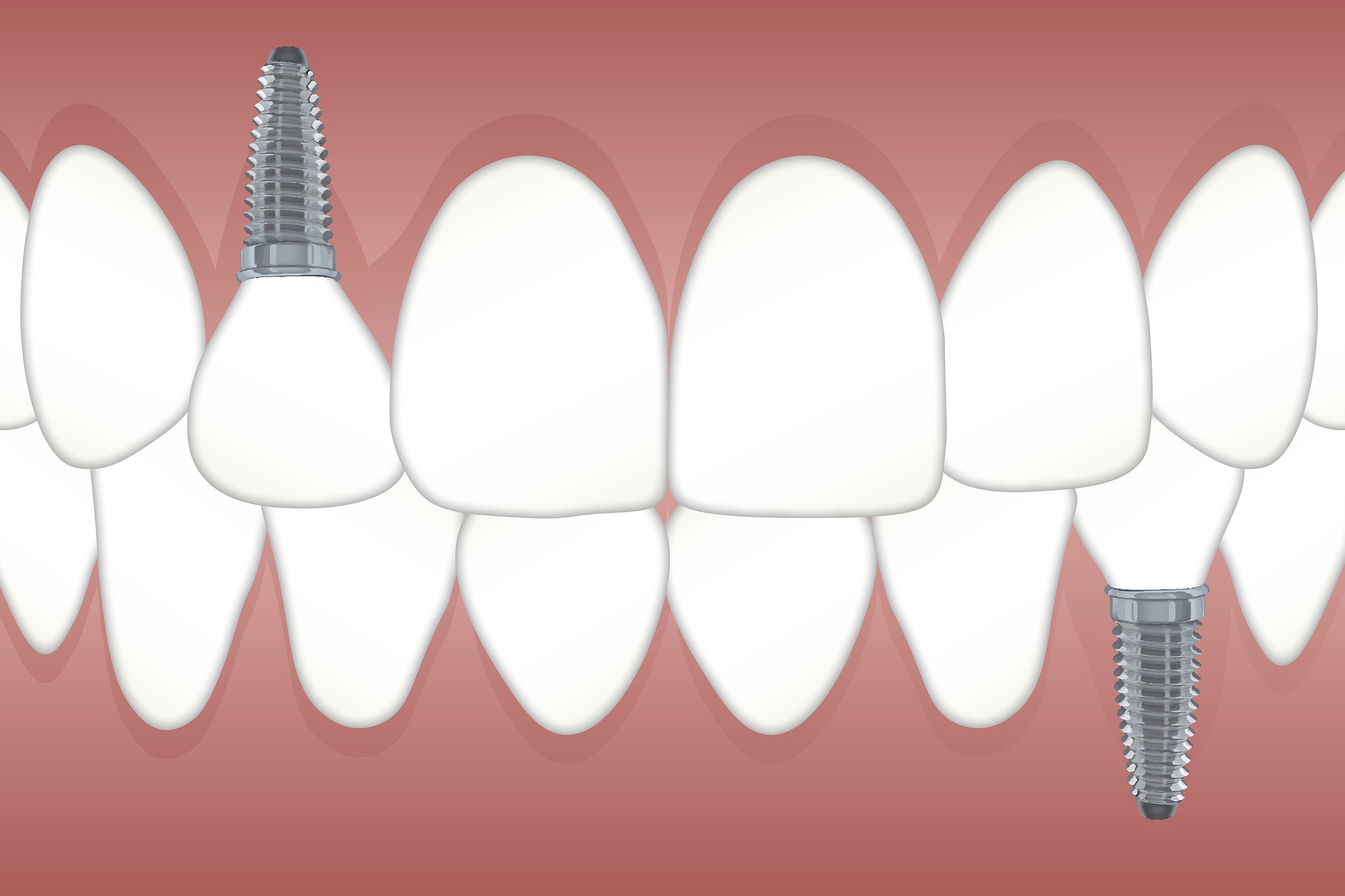 implant